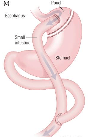 Bypass gastrique en Y (BPGY). Bray GA, et al. Une anse alimentaire relie une petite poche gastrique à l’intestin grêle. Le pied de cette anse alimentaire transportant les aliments est anastomosé à la portion intestinale court-circuitée. Bray GA, et al. Endocr Rev. 2018 Apr 1;39(2):79-132.