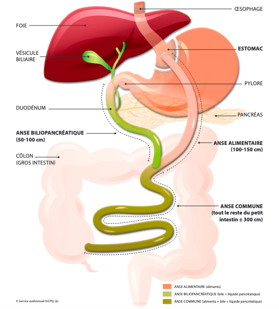 Sleeve gastrectomy. © Institut universitaire de cardiologie et de pneumologie de Québec. Université Laval