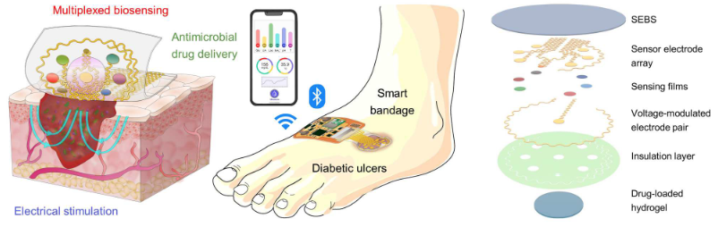 Vue schématique d’un pansement intelligent sur une plaie chronique infectée du pied d’un patient diabétique. Composition des multiples éléments composant un pansement intelligent : polymère (SEBS), rangée de biosenseurs électrochimiques, paire d’électrodes pour contrôler la libération d’une substance pharmacologiquement active et délivrer une électrostimulation, couche d’hydrogel électroactif renfermant un principe actif antibactérien. Shirzaei Sani E, et al. Sci Adv. 2023 Mar 24;9(12):eadf7388.