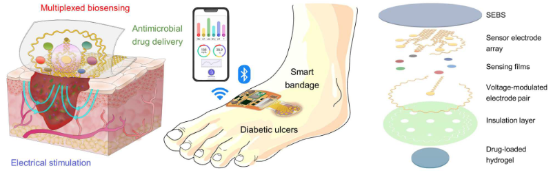 Vue schématique d’un pansement intelligent sur une plaie chronique infectée du pied d’un patient diabétique. Composition des multiples éléments composant un pansement intelligent : polymère (SEBS), rangée de biosenseurs électrochimiques, paire d’électrodes  pour contrôler la libération d’une substance pharmacologiquement active et délivrer une électrostimulation, couche d’hydrogel électroactif renfermant un principe actif antibactérien. Shirzaei Sani E, et al. Sci Adv. 2023 Mar 24;9(12):eadf7388.