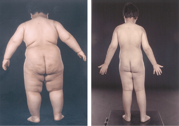 Exemple d’obésité génétique à début précoce. Enfant souffrant d’un déficit congénital en leptine, avant et après traitement par la leptine recombinante. Il ne s’agit pas d’un des enfants dont le cas a été rapporté dans le NEJM. Farooqi IS, et al. J Clin Invest. 2002 Oct;110(8):1093-103.