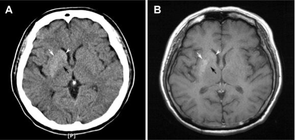 Images typiques au scanner (A) et à l'IRM (séquence pondérée en T1) montrant des anomalies du striatum, en l’occurrence du putamen (flèches blanches) et du noyau caudé (pointes de flèches blanches). Chua CB, et al. Sci Rep. 2020 Jan 31;10(1):1594.