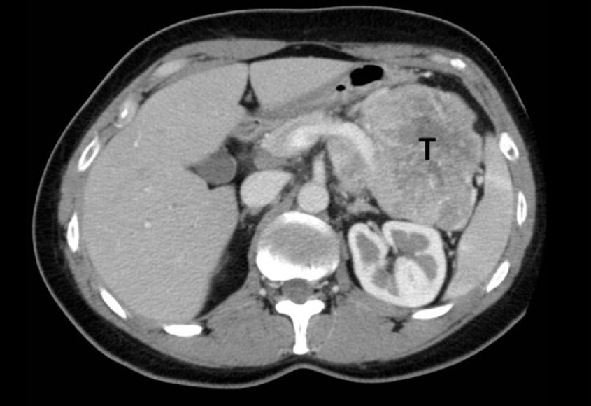Scanner préopératoire. Une grosse tumeur (T) est visible dans la queue du pancréas. Gjelberg HK, et al. Clin Case Rep. 2017 Apr 6;5(6):761-768.