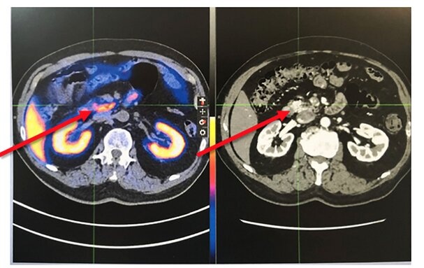 Tomographie par émission de positons marqués au 68Ga-DOTATATE montrant la présence d’une tumeur de la tête du pancréas (flèches rouges). Chang JY, et al. Front Endocrinol (Lausanne). 2022 Jul 22;13:957369.