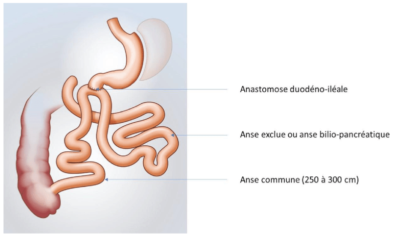 Illustration de la SADI-S. Court-circuit duodéno-iléal avec gastrectomie longitudinale ou SADI-Sleeve.