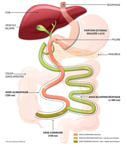Dérivation biliopancréatique. © Institut universitaire de cardiologie et de pneumologie de Québec. Université Laval.