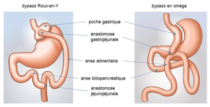 Illustration des deux techniques de bypass : Roux-en-Y et oméga. HAS, mars 2019.