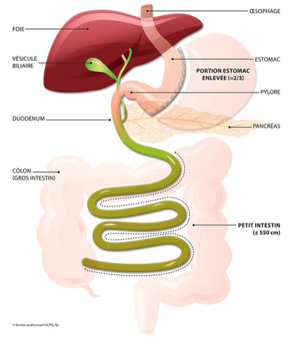 Sleeve gastrectomy. © Institut universitaire de cardiologie et de pneumologie de Québec. Université Laval