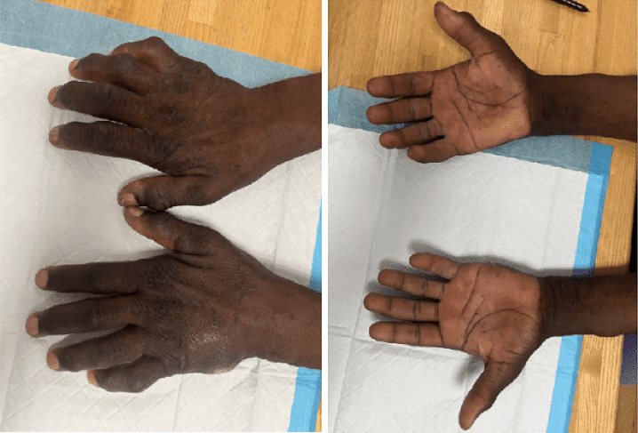 chéiroarthropathie diabétique main diabétique diabète complication
