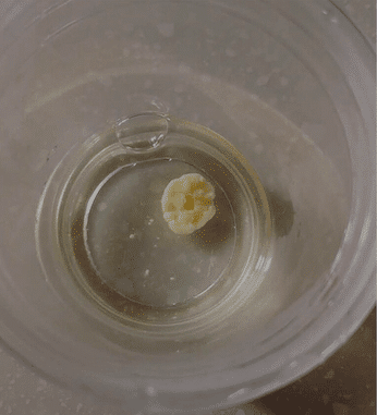 Les boules fungiques (fungus balls) sont des grumeaux ou amas de fins filaments mycéliens (champignons). Sur cette photo, l’amas a un diamètre de 1,5 cm. Chang CY, Hsieh MH. N Engl J Med. 2022 Jul 7;387(1):e2.