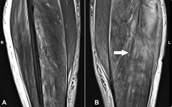 Infarctus musculaire diabétique IRM cuisse muscle