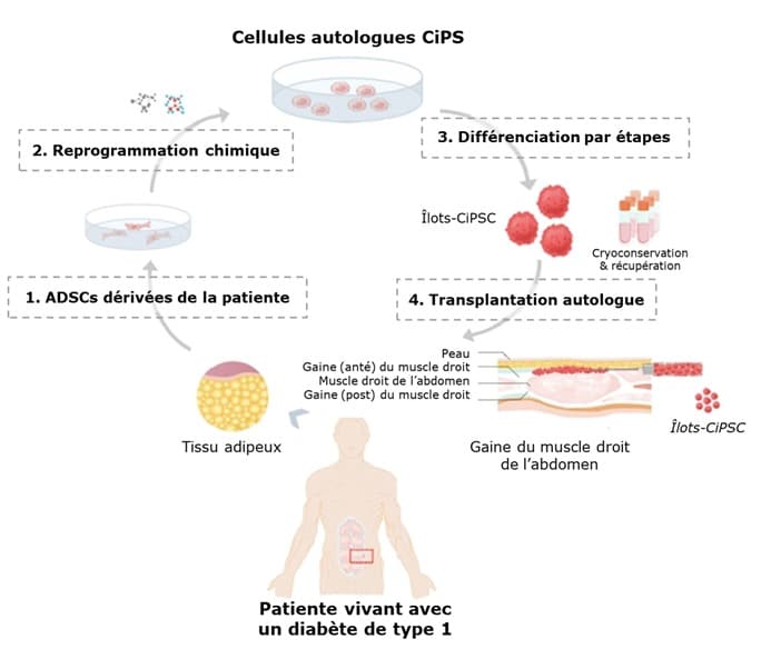 Protocole de l’essai clinique. ADSCs : cellules stromales mésenchymateuses du tissu adipeux dérivé de la patiente. La procédure comporte d’abord une reprogrammation chimique des cellules du tissu adipeux (ADSCs) qui précède leur différenciation progressive en des cellules d’îlots. CiPS (chemically induced pluripotent stem-cell-derived islets) : îlots dérivés de cellules souches pluripotentes chimiquement. Celles-ci ont ensuite été transplantées dans la gaine du muscle droit de l’abdomen. Adapté de Wang S, et al. Cell. 2024 Sep 20:S0092-8674(24)01022-5.