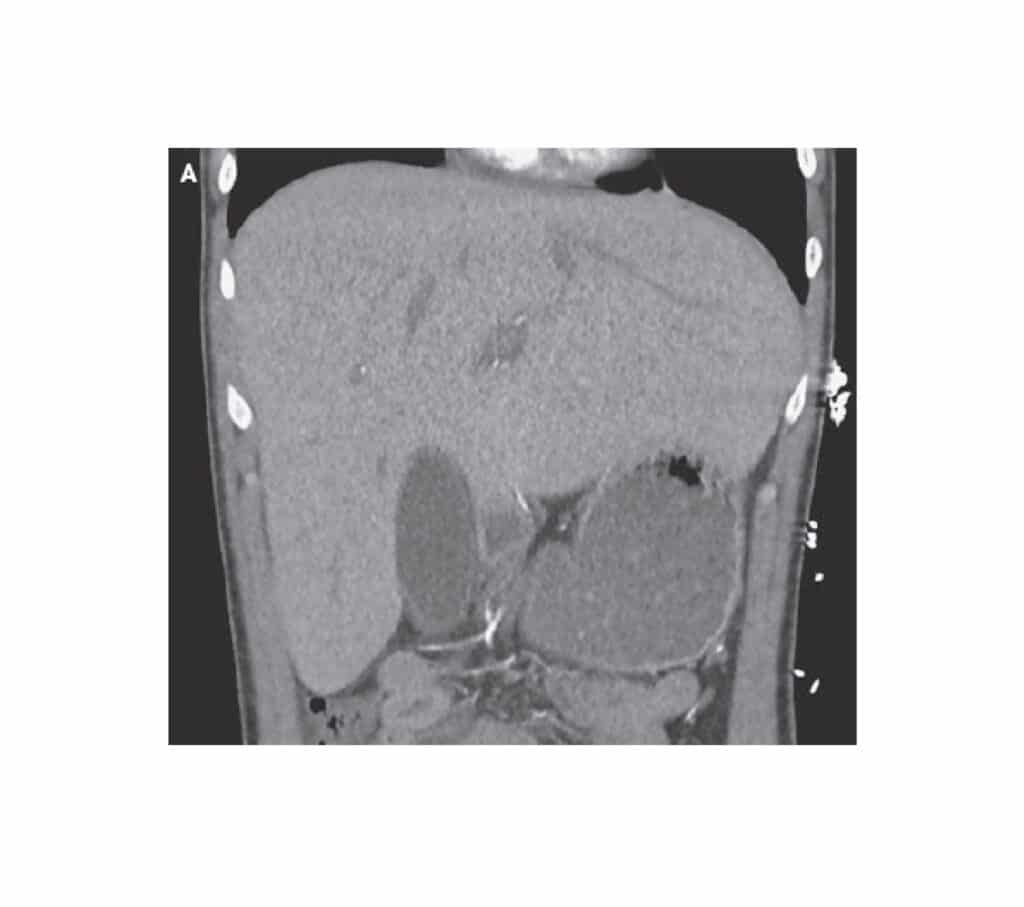 Scanner abdominal montrant un gros foie (hépatomégalie), sans modification du parenchyme hépatique. Sjöholm Å, et al. N Engl J Med. 2024 Oct 24;391(16):1528.