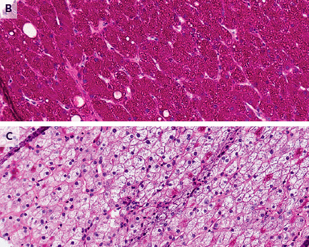 Biopsie du foie : hépatocytes enflés avec un dépôt abondant de glycogène dans le cytoplasme. B : coloration positive à l'acide périodique de Schiff. Les hépatocytes sont colorés en rose du fait de leur surcharge en glycogène. C : cette coloration disparaît après action de la diastase qui digère les dépôts. Sjöholm Å, et al. N Engl J Med. 2024 Oct 24;391(16):1528.